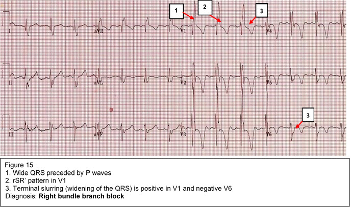 Diagnosis: Right bundle branch block