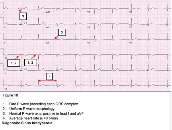 Diagnosis: Sinus bradycardia