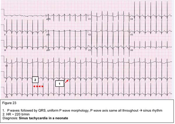 Arrhythmias