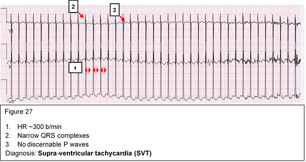 Diagnosis: Supra-ventricular tachycardia (SVT)