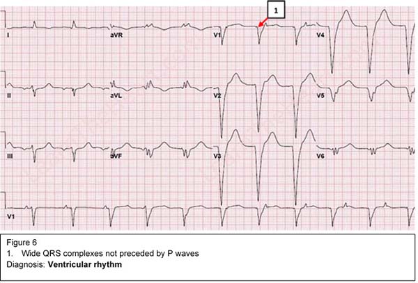 Diagnosis: Ventricular Rhythm