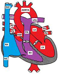 picture Secundum Atrial Septal Defect