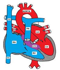 Atrioventricular Septal Defect