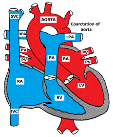 Coaractation of aorta