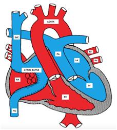 D-TGA after atrial switch surgery