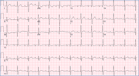 Arrhythmias