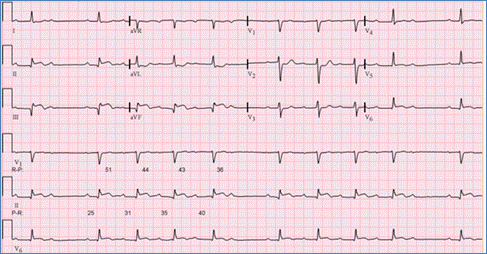 Arrhythmias