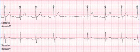 Arrhythmias