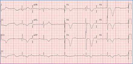 Arrhythmias