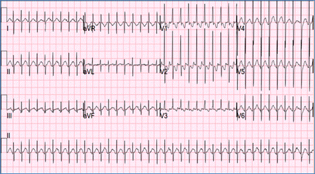 Arrhythmias