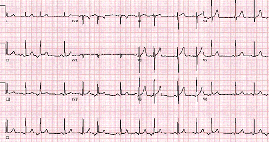 Arrhythmias