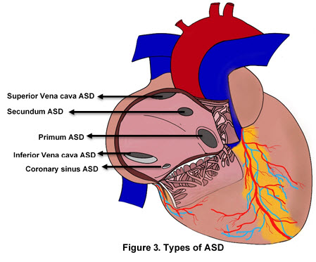 Figure 3. Types of ASD