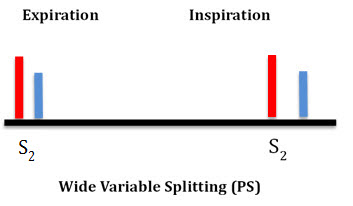 Wide Variable Splitting (PS)