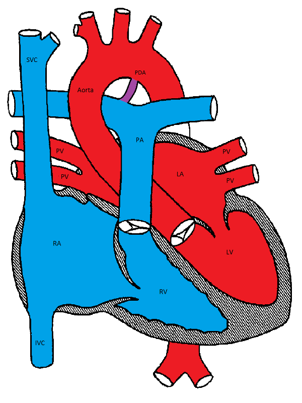 Оап у новорожденных. Открытый артериальный (боталлов) проток. Артериальный боталлов проток. Боталлов проток анатомия. Открытый аортальный проток.