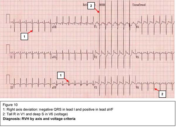 Diagnosis: RVH by axis and voltage criteria