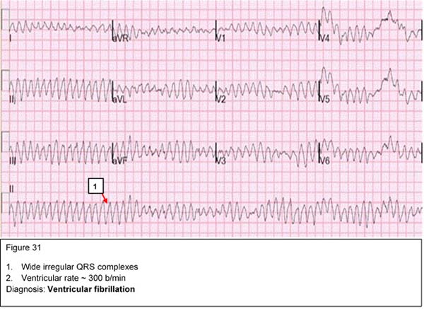 Diagnosis: Ventricular fibrillation