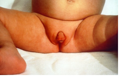 female infant with ambiguous genitalia