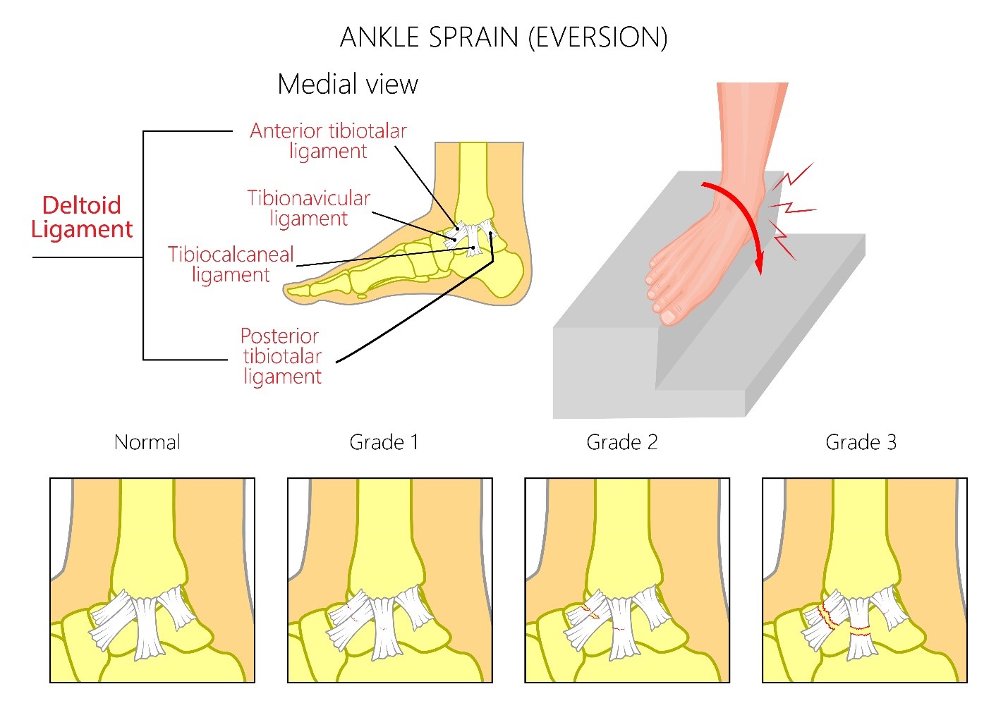 Sprained Ankle - SportsMD