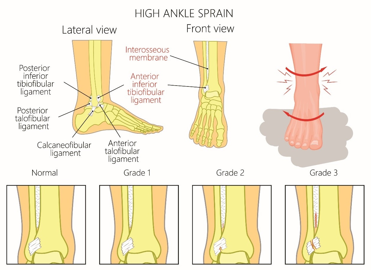 deltoid ligament ankle sprain