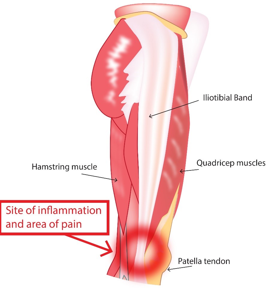 Knee Injuries