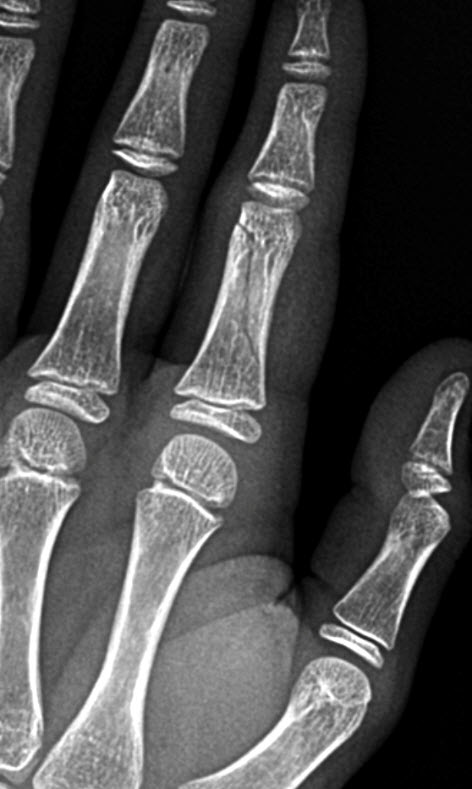 Thumb Proximal Phalanx Fracture