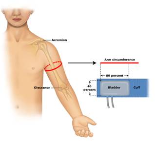 Determining_BP_cuff_size