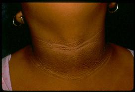 Acanthosis nigricans